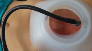 Результаты ВДГК. Консервативное лечение с помощью Вакуумного колокола