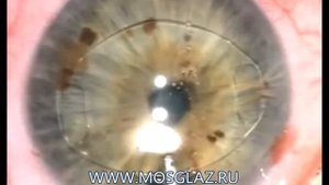 Установка переднекамерной интраокулярной линзы (ИОЛ) Артисан (Artisan)