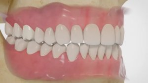 Установка имплантатов Nobel.