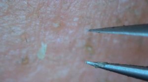 0227 keratin plug removal nose