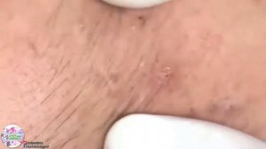 УГРИ   ПРЫЩИ НА ЛИЦЕ! ДАВЛЮ Как избавиться от черноголовых ! How to get rid of blackheads2
