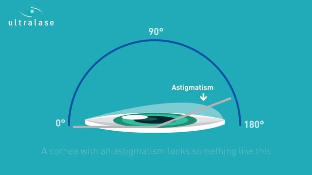 Astigmatism Axis Explained | Ultralase Eye Clinics Ltd смотреть онлайн