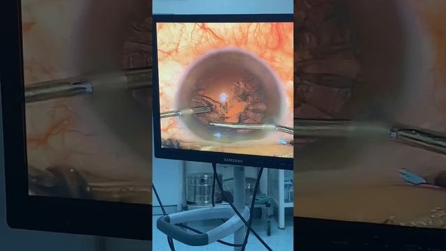 Kataraktanın fakoemulsifikasiyası + Göz içi linza implantasiyası əməliyyatı смотреть онлайн