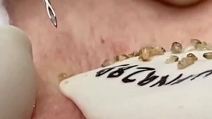 Relax With Mr Pimple Popper | acne treatment | Blackheads Removal #029