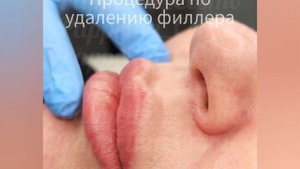 Удаление гиалуроновых усов