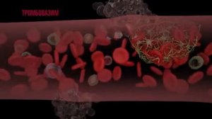 ТРОМБОВАЗИМ   демонстрационный ролик