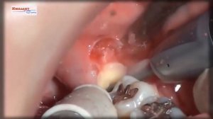 Удаление 8 зуба  зуба мудрости в стоматологии