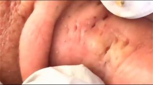 Выдавливаем прыщи.