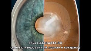 Вторичная катаракта после замены хрусталика (фиброз задней капсулы)