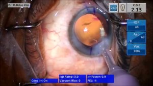 Pearls for Easy Setup and Positioning of a Toric IOL