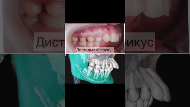 Виды неправильного прикуса