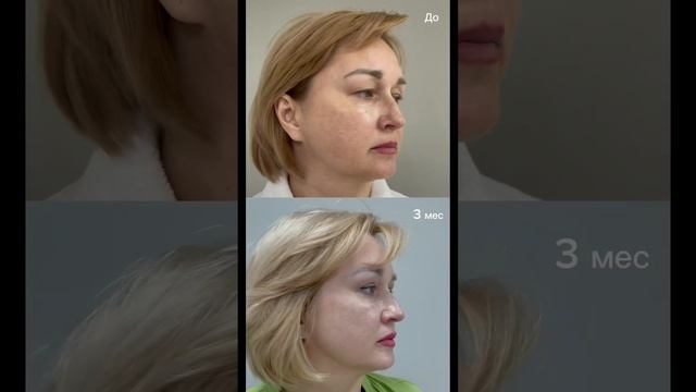 Верхняя блефаропластика в руках опытного доктора - простая операция с предсказуемым результатом ☺️