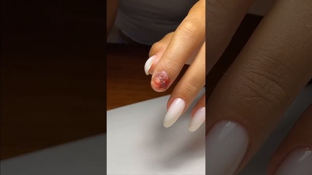 Сорванный ноготь смотреть онлайн