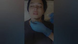 Процедуры на камеру. Увеличение губ и коррекция ассиметрии