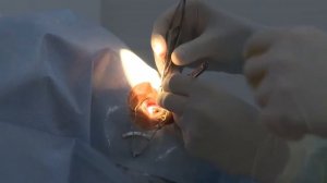 Операция по исправлению косоглазия