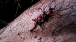 Пьявки пьют кровь из раны./Blood Meeting. Hungry leeches