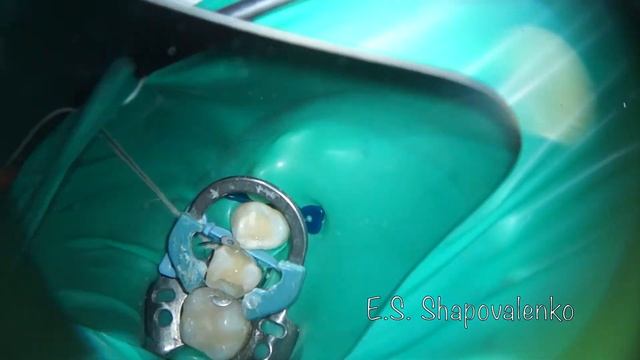 кариес под микроскопом смотреть онлайн