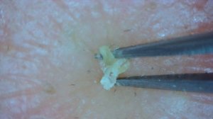0229 keratin plug removal nose