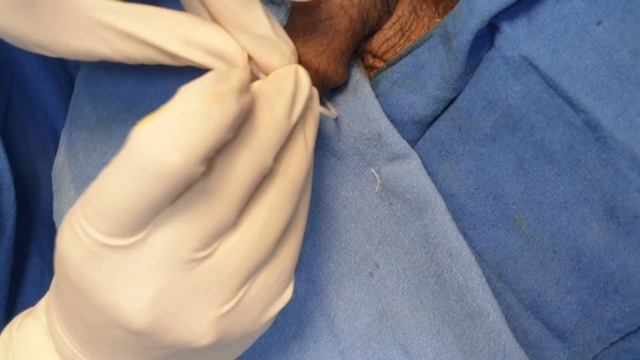 Painless and Bloodless Stapler Circumcision at Urocentre смотреть онлайн