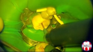 Зуб 3.6 ... Лечение кариеса с помощью окклюзионного шаблона