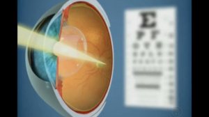 Имплантация факичных линз