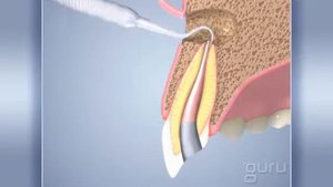 резекция верхушки корня