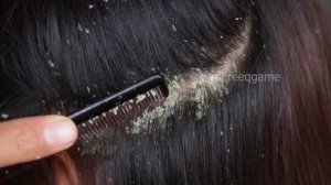 Combing Big Dandruff Flakes!!! Dandruff Scratching Satisfying #672