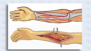 Переломы костей предплечья