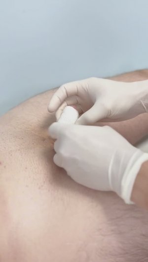 ВИДЕОИНСТРУКЦИЯ: Первая перевязка после операции #ОБРЕЗАНИЕ КРАЙНЕЙ ПЛОТИ  #уролог #Доценко