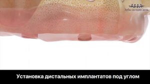 Если долго отсутствуют зубы. Последствия атрофии костной ткани. Сеть клиник Зубы за один день