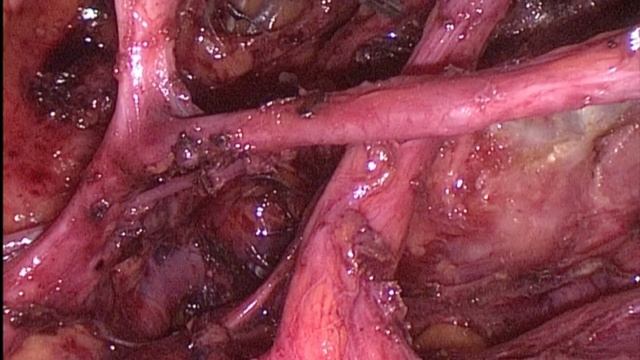 Radical Trachelectomy with Ascending Branches of Uterine Arteries Preservation смотреть онлайн