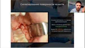 Вебинар: Зубы мудрости - важные аспекты успешной хирургии