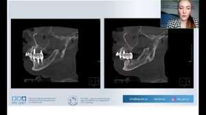 Тотал≠фатал. Планирование и подготовка к ортопедической реабилитации пациентов с ДВНЧС.