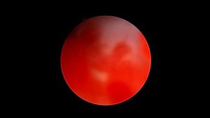 Артроскопия коленного сустава при частичном разрыве передней крестовидной связки