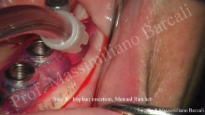 Guided Surgery - TAG Dental Implants -