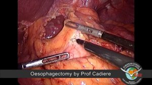 Esophagectomy / Oesophagectomie by Professor Guy-Bernard Cadiere HD