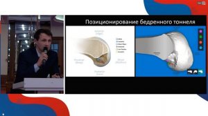 Принципы реконструкции ПКС у активных пациентов.  "Приоровские чтения-2023". Доклад Миленина О.Н.