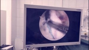 Частичный разрыв передней крестообразной связки коленного сустава