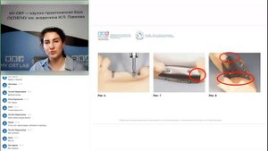 Обзор методик костных пластик  от простого к усложненным протоколам