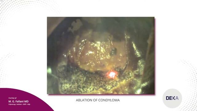 COLPOSCOPY - Endocervical HSIL CIN II
