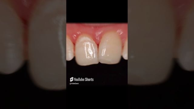 Откололся зуб_ Скол переднего зуба - реставрация за 1 посещение!