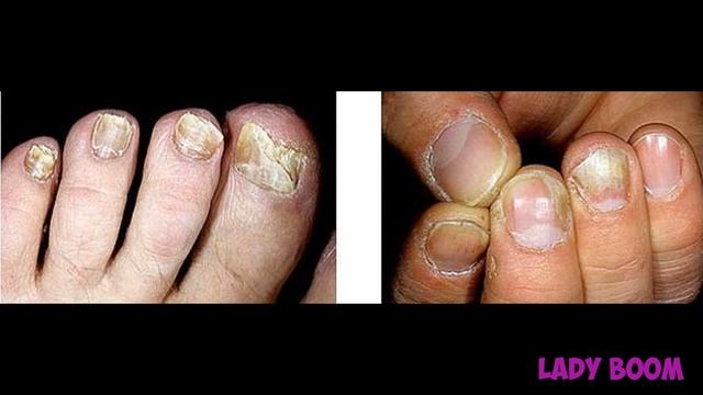 ПРОСТОЙ Метод Как Вылечить ГРИБОК НОГТЕЙ. Эффективное средство от грибка ногтей смотреть онлайн