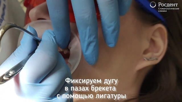 Процесс простановки брекет-системы