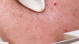 Удаление черных точек очень приятное