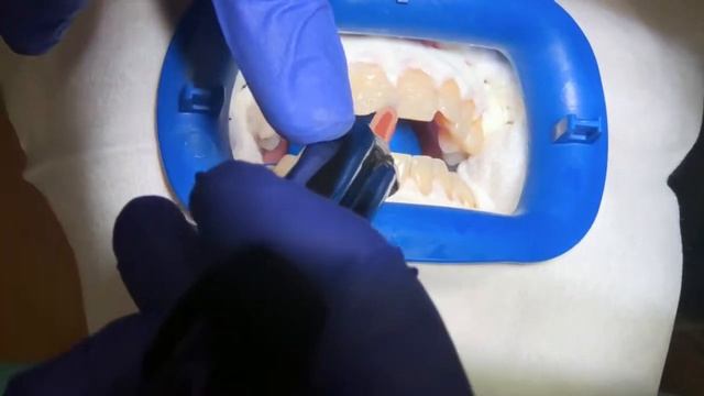 Отбеливание зубов ZOOM 4 в Belgravia Dental Studio