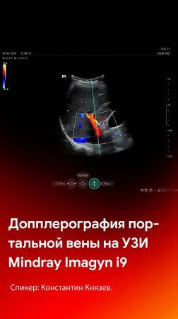 Допплерография портальной вены на Mindray Imagyn i9