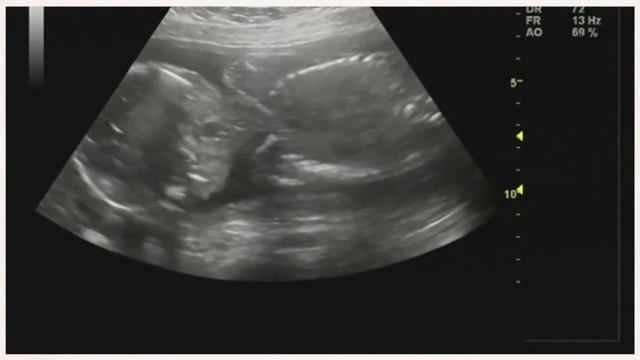 УЗИ на 25 неделе беременности смотреть онлайн