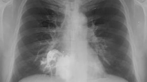 По следам белой смерти