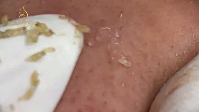 Clear Skin Secrets How to Get Rid of Blackheads смотреть онлайн