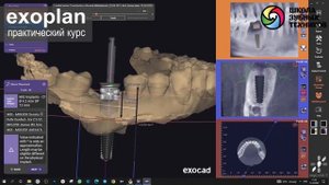 Создание хирургических шаблонов в программе exoplan